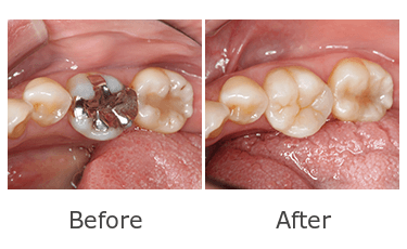 審美歯科症例1